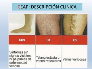 CEAP: DESCRIPCIÓN CLINICA
 