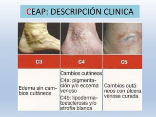 CEAP: DESCRIPCIÓN CLINICA
 