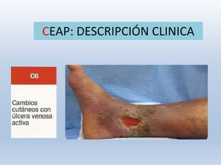 CEAP: DESCRIPCIÓN CLINICA
 
