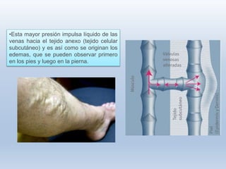 •Esta mayor presión impulsa líquido de las
venas hacia el tejido anexo (tejido celular
subcutáneo) y es así como se originan los
edemas, que se pueden observar primero
en los pies y luego en la pierna.
 