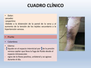 CUADRO CLÍNICO
.
.
•
• Dolor:
-pesadez
-vespertino
-Debido a la distensión de la pared de la vena y al
aumento de la tensión de los tejidos secundario a la
hipertensión venosa.
• Prurito
• Edema:
- líquido en el espacio intersticial por de la presión
venosa capilar que lleva la fuga de fluido desde el
espacio intravascular.
- signo de la fóvea positiva, unilateral y se agrava
durante el día.
• Calambres
 