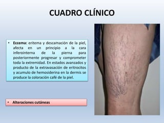• Alteraciones cutáneas
• Eccema: eritema y descamación de la piel,
afecta en un principio a la cara
inferointerna de la pierna para
posteriormente progresar y comprometer
toda la extremidad. En estados avanzados y
producto de la extravasación de eritrocitos
y acumulo de hemosiderina en la dermis se
produce la coloración café de la piel.
CUADRO CLÍNICO
 
