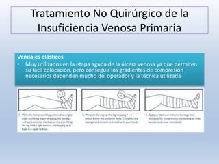 Tratamiento No Quirúrgico de la
Insuficiencia Venosa Primaria
Vendajes elásticos
• Muy utilizados en la etapa aguda de la úlcera venosa ya que permiten
su fácil colocación, pero conseguir los gradientes de compresión
necesarios dependen mucho del operador y la técnica utilizada
 