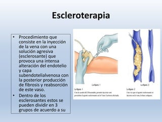 Escleroterapia
• Procedimiento que
consiste en la inyección
de la vena con una
solución agresiva
(esclerosante) que
provoca una intensa
alteración del endotelio
y capa
subendotelialvenosa con
la posterior producción
de fibrosis y reabsorción
de este vaso.
• Dentro de los
esclerosantes estos se
pueden dividir en 3
grupos de acuerdo a su
 