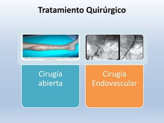 Tratamiento Quirúrgico
Cirugía
abierta
Cirugía
Endovascular
 