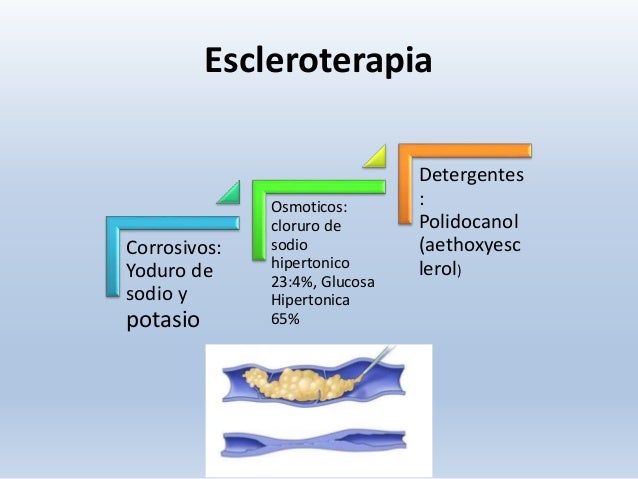 El magullado de la vena en los pies el tratamiento
