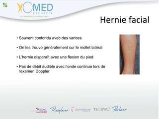 Hernie facial •  Souvent confondu avec des varices •  On les trouve généralement sur le mollet latéral •  L’hernie disparaît avec une flexion du pied •  Pas de débit audible avec l’onde continue lors de  l'examen Doppler 