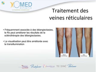 Traitement des  veines réticulaires •  Fréquemment associée à des télangiectasies,  le Rx peut améliorer les résultats de la  sclérothérapie des télangiectasies. •  La  visualisation peut être améliorée avec  la transillumination 