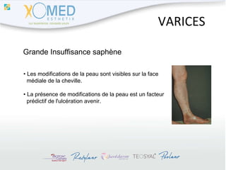 VARICES Grande Insuffisance saphène •  Les modifications de la peau sont visibles sur la face  médiale de la cheville. •  La présence de modifications de la peau est un facteur  prédictif de l'ulcération avenir. 
