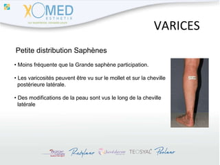 VARICES Petite distribution Saphènes •  Moins fréquente que la Grande saphène participation. •  Les varicosités peuvent être vu sur le mollet et sur la cheville  postérieure latérale. •  Des modifications de la peau sont vus le long de la cheville  latérale 