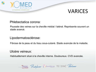 VARICES Poussée des veines sur la cheville médial / latéral. Représente souvent un  stade avancé. Habituellement situé à la cheville interne. Douloureux. CVD avancée. Fibrose de la peau et du tissu sous-cutané. Stade avancée de la maladie. Phlebectatica corona: Lipodermatosclérose: Ulcère veineux: 