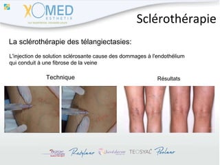 Sclérothérapie La sclérothérapie des télangiectasies: L'injection de solution sclérosante cause des dommages à l'endothélium  qui conduit à une fibrose de la veine Technique Résultats 