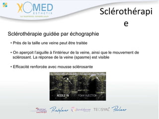 Sclérothérapie Sclérothérapie guidée par échographie •  Près de la taille une veine peut être traitée •  On aperçoit l’aiguille à l'intérieur de la veine, ainsi que le mouvement de  sclérosant. La réponse de la veine (spasme) est visible •  Efficacité renforcée avec mousse sclérosante 
