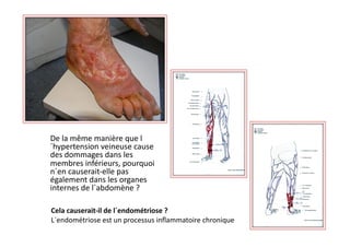     De	
  la	
  même	
  manière	
  que	
  l
       ´hypertension	
  veineuse	
  cause	
  
       des	
  dommages	
  dans	
  les	
  
       membres	
  inférieurs,	
  pourquoi	
  
       n´en	
  causerait-­‐elle	
  pas	
  
       également	
  dans	
  les	
  organes	
  
       internes	
  de	
  l´abdomène	
  ?	
  

	
     	
  Cela	
  causerait-­‐il	
  de	
  l´endométriose	
  ?	
  
       L´endométriose	
  est	
  un	
  processus	
  inﬂammatoire	
  chronique	
  
 