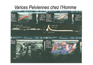 Varices Pelviennes chez l’Homme
 