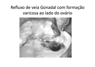 Reﬂuxo	
  de	
  veia	
  Gonadal	
  com	
  formação	
  
     varicosa	
  ao	
  lado	
  do	
  ovário	
  
 