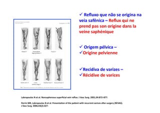 Reﬂuxo	
  que	
  não	
  se	
  origina	
  na	
  
                                                                                         	
  
                                                                                       veia	
  safênica	
  –	
  Reﬂux	
  qui	
  ne	
  
                                                                                              1
                                                                                       prend	
  pas	
  son	
  origine	
  dans	
  la	
  
                                                                                       veine	
  saphénique	
  


                                                                                        Origem	
  pélvica	
  –	
  	
  
                                                                                        	
  
                                                                                         rigine	
  pelvienne	
  
                                                                                        O


                                                                                         ecidiva	
  de	
  varizes	
  –	
  	
  
                                                                                        R
                                                                                         écidive	
  de	
  varices	
  
                                                                                        R



Labropoulos	
  N	
  et	
  al.	
  Nonsaphenous	
  superﬁcial	
  vein	
  reﬂux.	
  J	
  Vasc	
  Surg.	
  2001;34:872–877.	
  

Perrin	
  MR,	
  Labropoulos	
  N	
  et	
  al.	
  Presenta8on	
  of	
  the	
  pa8ent	
  with	
  recurrent	
  varices	
  ajer	
  surgery	
  (REVAS).	
  	
  
J	
  Vasc	
  Surg.	
  2006;43(2):327-­‐	
  	
  
 