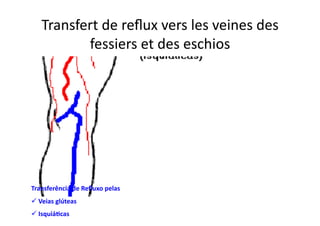Transfert	
  de	
  reﬂux	
  vers	
  les	
  veines	
  des	
  
           fessiers	
  et	
  des	
  eschios	
  




Transferência	
  de	
  Reﬂuxo	
  pelas	
  
 Veias	
  glúteas	
  
 	
  
 Isquiá8cas	
  
 	
  
 