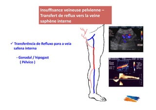 Insuﬃsance	
  veineuse	
  pelvienne	
  –	
  
                                                                      Transfert	
  de	
  reﬂux	
  vers	
  la	
  veine	
  
                                                                      saphène	
  interne	
  



 Transferência	
  de	
  Reﬂuxo	
  para	
  a	
  veia	
  
              	
  
	
  	
  	
  	
  safena	
  interna	
  

	
  	
  	
  	
  	
  	
  	
  -­‐	
  Gonadal	
  /	
  hipogast	
  
	
  	
  	
  	
  	
  	
  	
  	
  	
  	
  	
  (	
  Pélvico	
  )	
  	
  	
  	
  	
  	
  	
  	
  
 