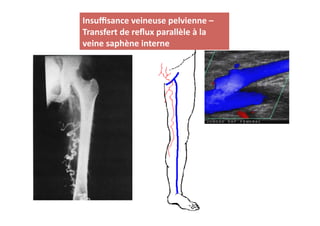 Insuﬃsance	
  veineuse	
  pelvienne	
  –	
  
Transfert	
  de	
  reﬂux	
  parallèle	
  à	
  la	
  
veine	
  saphène	
  interne	
  
 