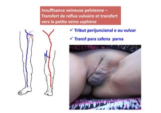 Insuﬃsance	
  veineuse	
  pelvienne	
  –	
  
Transfert	
  de	
  reﬂux	
  vulvaire	
  et	
  transfert	
  
vers	
  la	
  pe8te	
  veine	
  saphène	
  
                      Tribut	
  perijuncional	
  e	
  ou	
  vulvar	
  
                      	
  
                      Transf	
  para	
  safena	
  	
  parva	
  
                      	
  
 