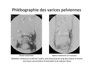 Phlébographie	
  des	
  varices	
  pelviennes	
  




              Avant	
  traitement	
                                     Après	
  traitement	
  à	
  la	
  mousse	
  
Dilata=on	
  variqueuse	
  à	
  côté	
  de	
  l´ovaire,	
  avec	
  beaucoup	
  de	
  sang	
  dans	
  lequel	
  se	
  trouve	
  
                une	
  haute	
  concentra=on	
  d´oestradiol	
  et	
  de	
  radicaux	
  libres	
  
 