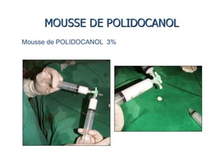 Mousse de POLIDOCANOL 3%
 