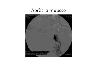 Après	
  la	
  mousse	
  
 