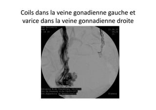 Coils	
  dans	
  la	
  veine	
  gonadienne	
  gauche	
  et	
  
varice	
  dans	
  la	
  veine	
  gonnadienne	
  droite	
  
 