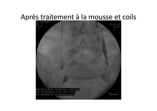 Après	
  traitement	
  à	
  la	
  mousse	
  et	
  coils	
  
 