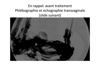 En	
  rappel:	
  avant	
  traitement	
  
Phlébographie	
  et	
  echographie	
  transvaginale	
  
                 (slide	
  suivant)	
  
 