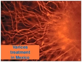 Varices
treatment
in Mexico
 
