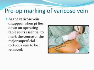 Pre-op marking of varicose vein
 As the varicose vein
disappear when pt lies
down on operating
table so its essential to
mark the course of the
major superficial
tortuous vein to be
removed.
 