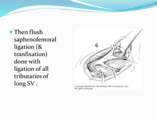  Then flush
saphenofemoral
ligation (&
tranfixation)
done with
ligation of all
tributaries of
long SV .
 