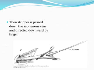  Then stripper is passed
down the saphenous vein
and directed downward by
finger .
.
 