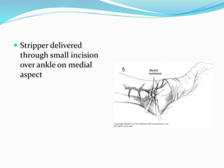  Stripper delivered
through small incision
over ankle on medial
aspect
 