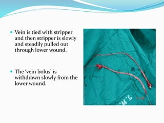  Vein is tied with stripper
and then stripper is slowly
and steadily pulled out
through lower wound.
 The ‘vein bolus’ is
withdrawn slowly from the
lower wound.
 