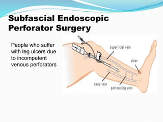 Subfascial Endoscopic
Perforator Surgery
People who suffer
with leg ulcers due
to incompetent
venous perforators
 