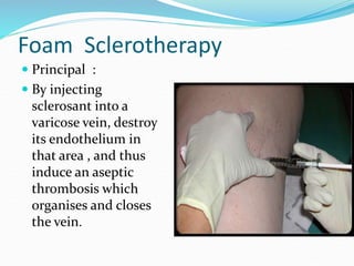 Foam Sclerotherapy
 Principal :
 By injecting
sclerosant into a
varicose vein, destroy
its endothelium in
that area , and thus
induce an aseptic
thrombosis which
organises and closes
the vein.
 