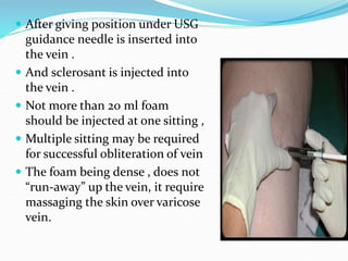  After giving position under USG
guidance needle is inserted into
the vein .
 And sclerosant is injected into
the vein .
 Not more than 20 ml foam
should be injected at one sitting ,
 Multiple sitting may be required
for successful obliteration of vein
 The foam being dense , does not
“run-away” up the vein, it require
massaging the skin over varicose
vein.
 