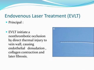 Endovenous Laser Treatment (EVLT)
 Principal :
 EVLT initiate a
nonthrombotic occlusion
by direct thermal injury to
vein wall, causing
endothelial denudation ,
collagen contraction and
later fibrosis.
 