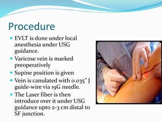 Procedure
 EVLT is done under local
anesthesia under USG
guidance.
 Varicose vein is marked
preoperatively
 Supine position is given
 Vein is canulated with 0.035” J
guide-wire via 19G needle.
 The Laser fiber is then
introduce over it under USG
guidance upto 2-3 cm distal to
SF junction.
 