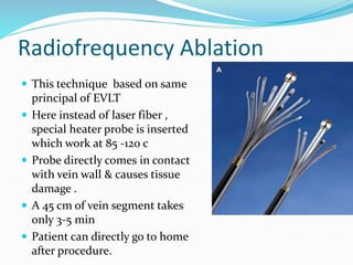 Radiofrequency Ablation
 This technique based on same
principal of EVLT
 Here instead of laser fiber ,
special heater probe is inserted
which work at 85 -120 c
 Probe directly comes in contact
with vein wall & causes tissue
damage .
 A 45 cm of vein segment takes
only 3-5 min
 Patient can directly go to home
after procedure.
 