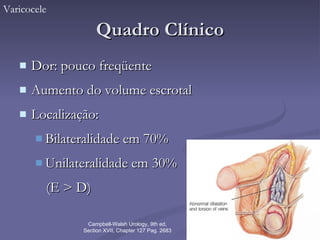 Quadro Clínico Dor: pouco freqüente Aumento do volume escrotal Localização: Bilateralidade em 70% Unilateralidade em 30%  (E > D) Varicocele Campbell-Walsh Urology, 9th ed, Section XVII, Chapter 127 Pag. 2683 
