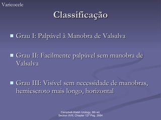 Classificação Grau I: Palpável à Manobra de Valsalva Grau II: Facilmente palpável sem manobra de Valsalva Grau III: Visível sem necessidade de manobras, hemiescroto mais longo, horizontal Varicocele Campbell-Walsh Urology, 9th ed, Section XVII, Chapter 127 Pag. 2684 