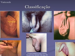 Classificação Varicocele Urologia Pediátrica Junior, Antônio Macedo Lima, Salvador Vilar pag. 246 