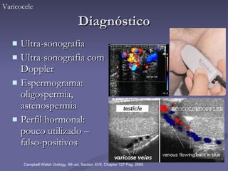 Diagnóstico Ultra-sonografia Ultra-sonografia com Doppler Espermograma: oligospermia, astenospermia  Perfil hormonal: pouco utilizado – falso-positivos Varicocele Campbell-Walsh Urology, 9th ed, Section XVII, Chapter 127 Pag. 2685 
