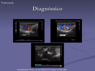 Diagnóstico Varicocele Campbell-Walsh Urology, 9th ed, Section XVII, Chapter 127 Pag. 2684 
