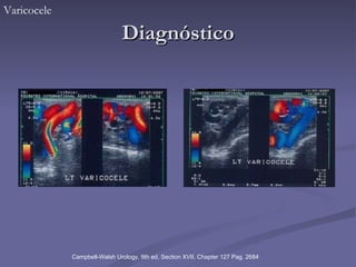 Diagnóstico Varicocele Campbell-Walsh Urology, 9th ed, Section XVII, Chapter 127 Pag. 2684 