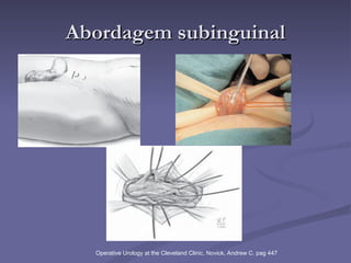 Abordagem subinguinal Operative Urology at the Cleveland Clinic, Novick, Andrew C. pag 447 